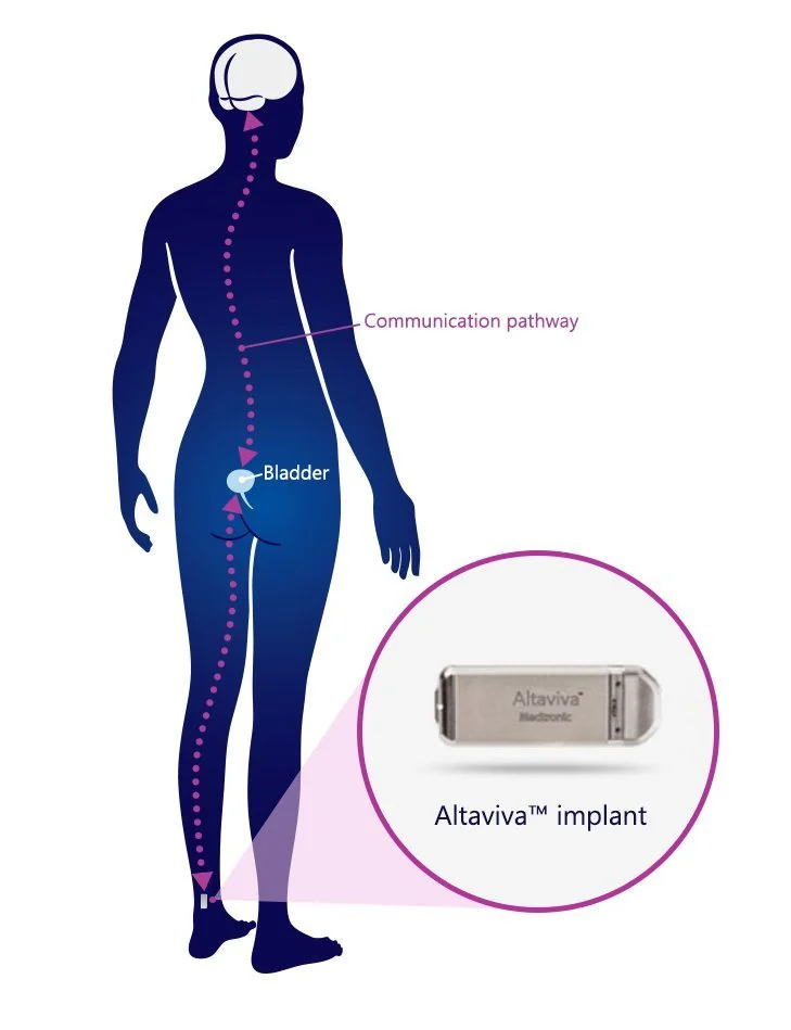 Diagram showing the communication pathway between the brain, bladder, and Altaviva implant near the ankle